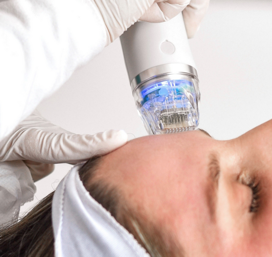 radio frequency microneedling, RF Skin care, MicroNeedling, skinfinity